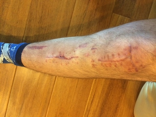 Leg like a battlefield, courtesy Aaron Simon.